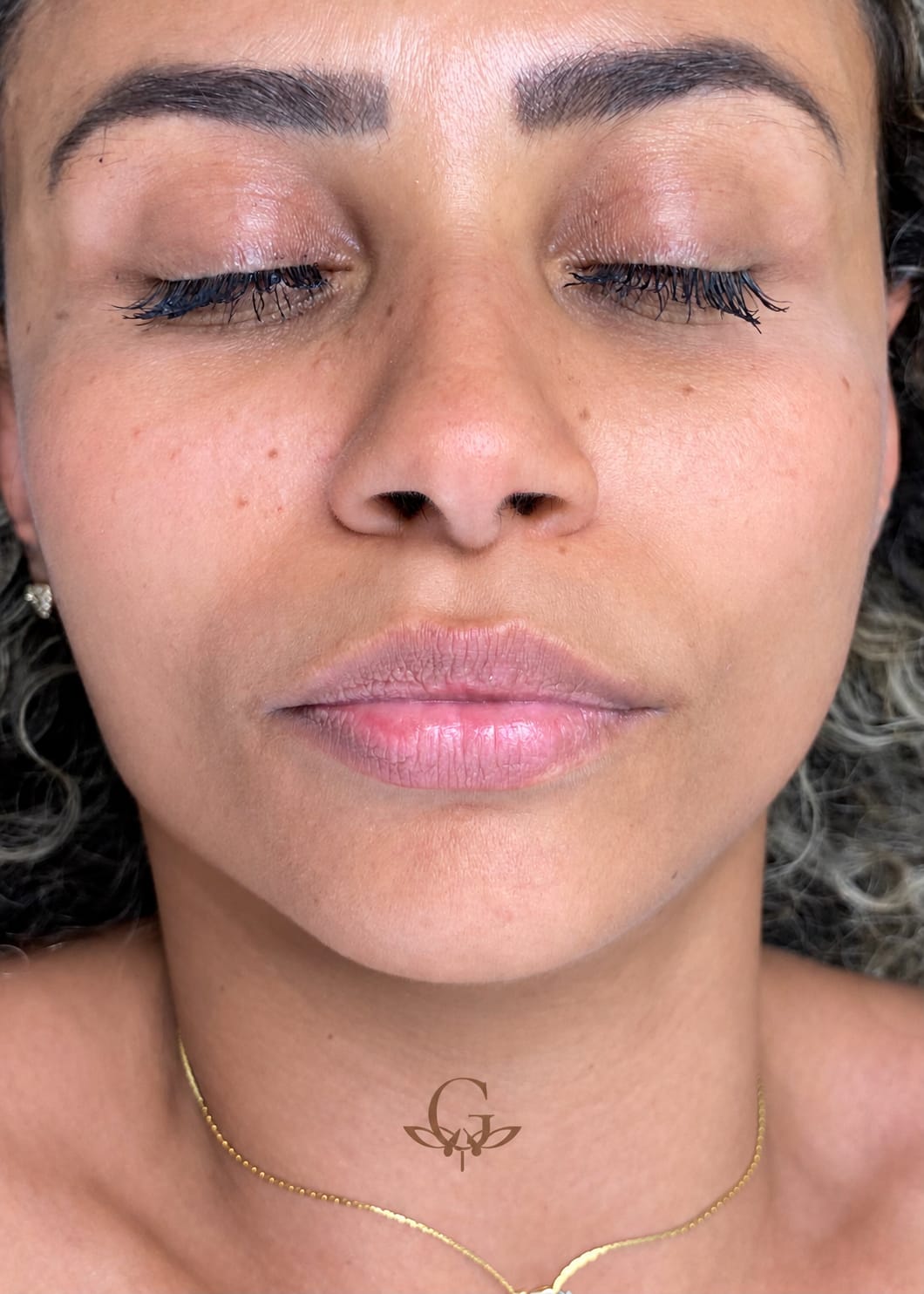 Antes do procedimento de Neutralização Labial