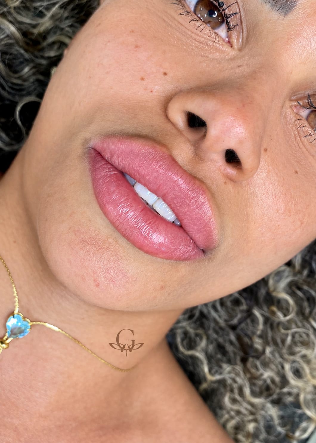 Depois do procedimento de Neutralização Labial