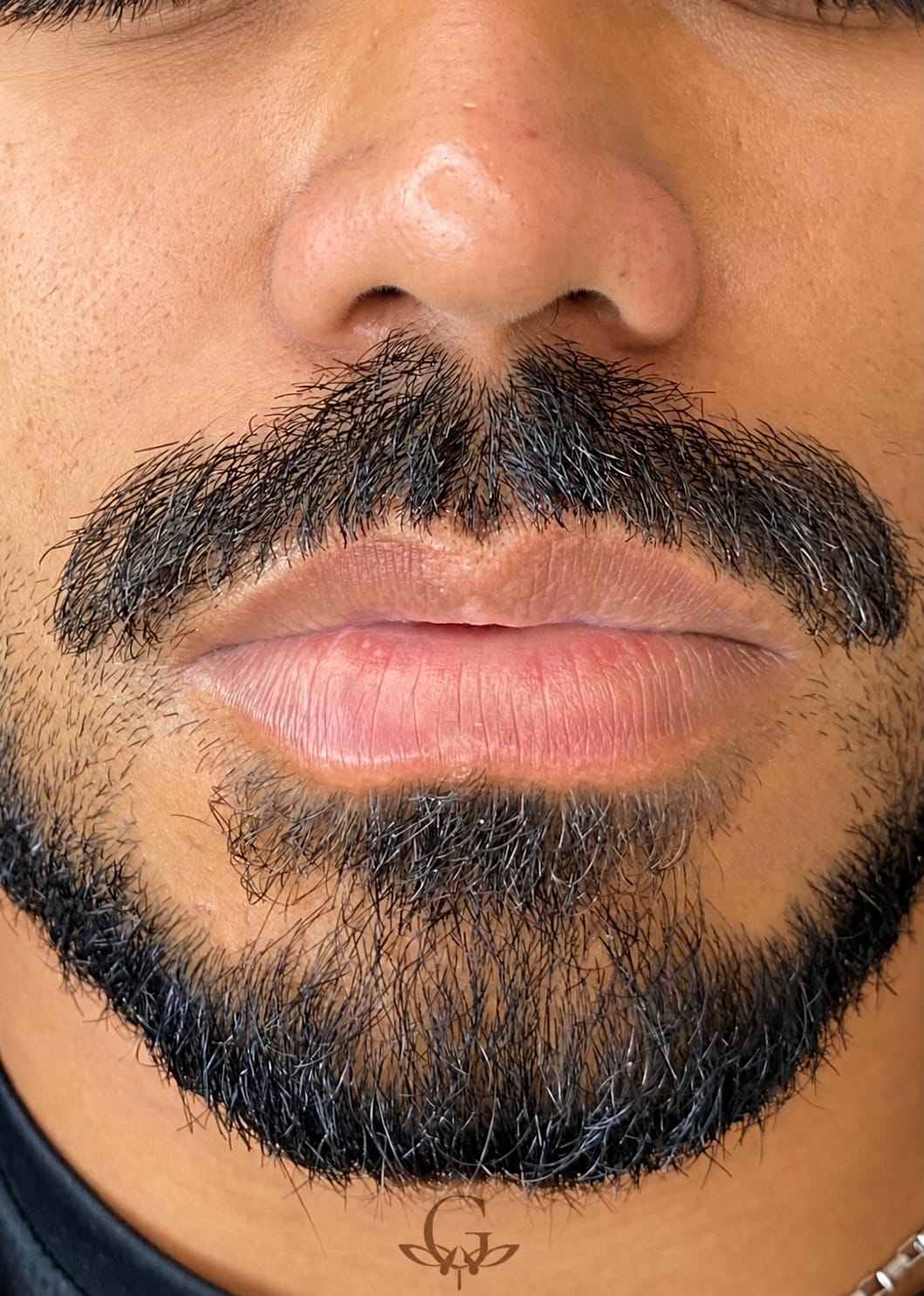 Antes do procedimento de Neutralização Labial