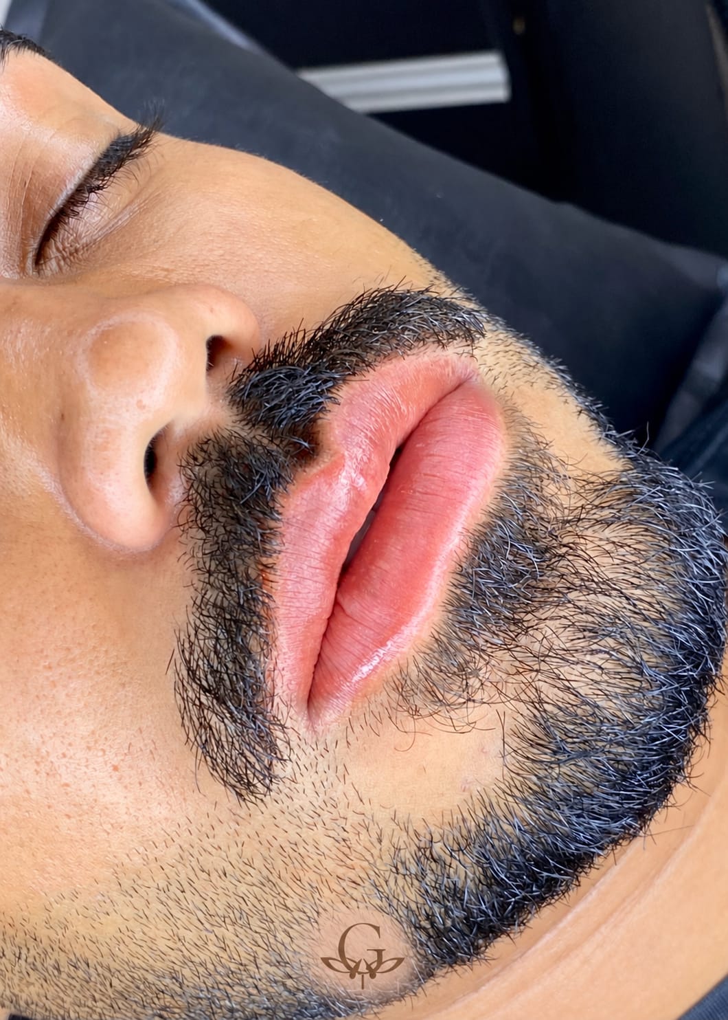 Depois do procedimento de Neutralização Labial