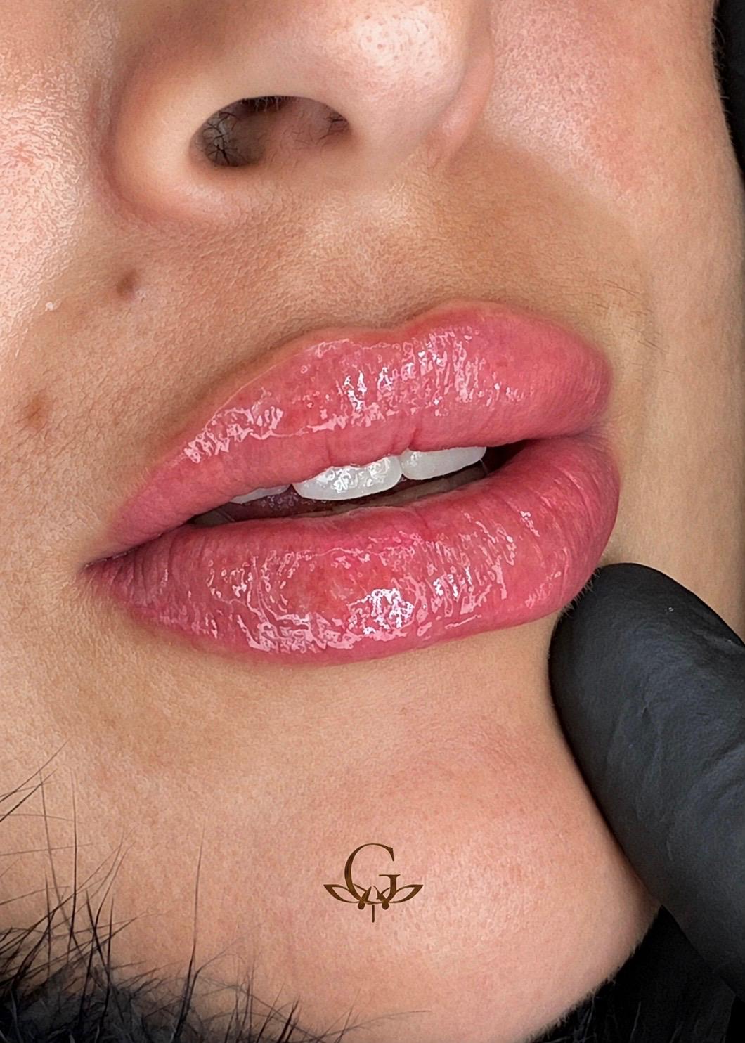 Resultado de Revitalização Labial