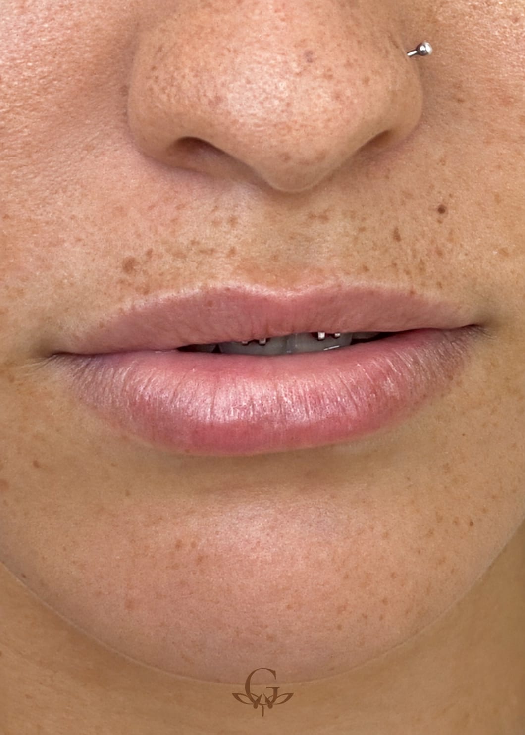 Antes do procedimento de Revitalização Labial