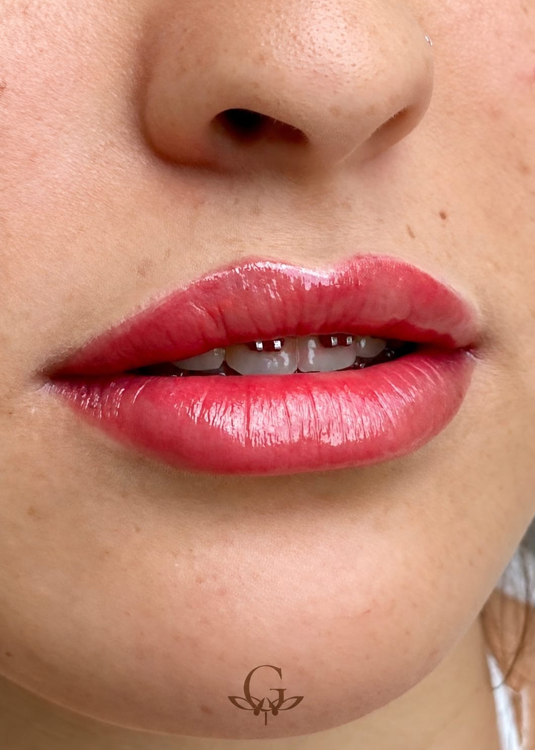 Depois do procedimento de Revitalização Labial